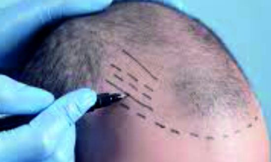 33-Painless Hair Transplant
