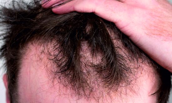 37-Male Hair loss Treatment