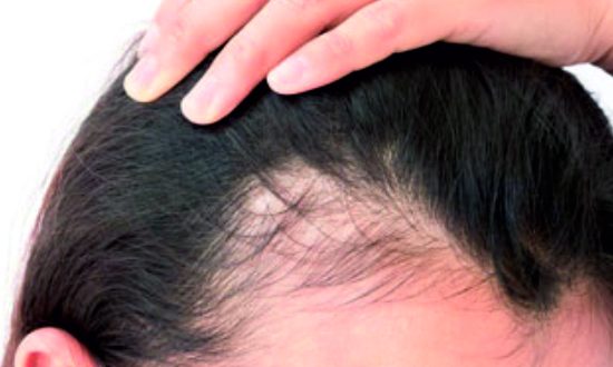 38-Female Hair loss Treatment