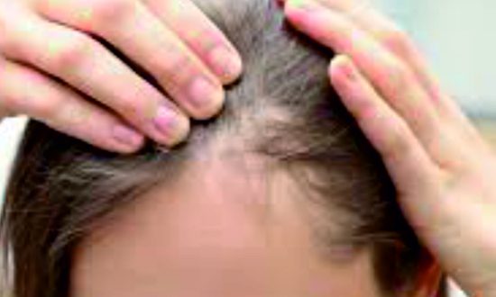 39-Alopecia Areata Treatment