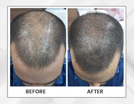 Dr. Pauls Best Hair Fall Treatment Doctor in Gurgaon