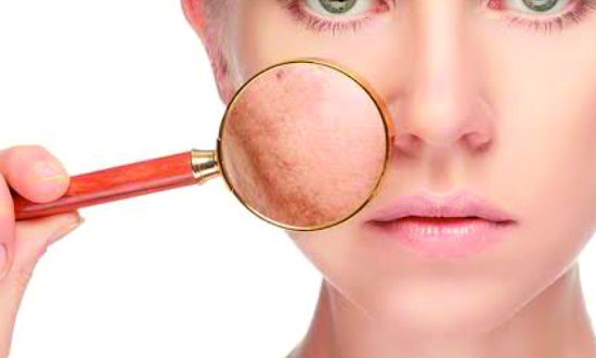 14-Pigmentation, Sun damage, Freckle, Dark Spots, Melasma Treatment