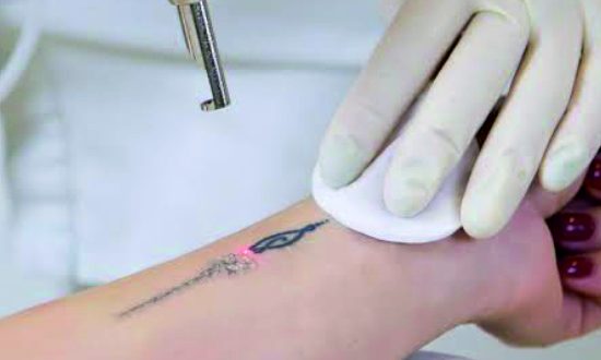 15-Tattoo Removal Treatment