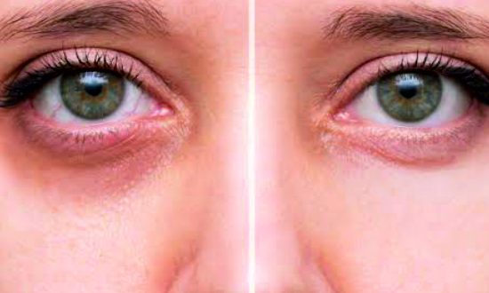 16-Under Eye Dark Circles Treatment