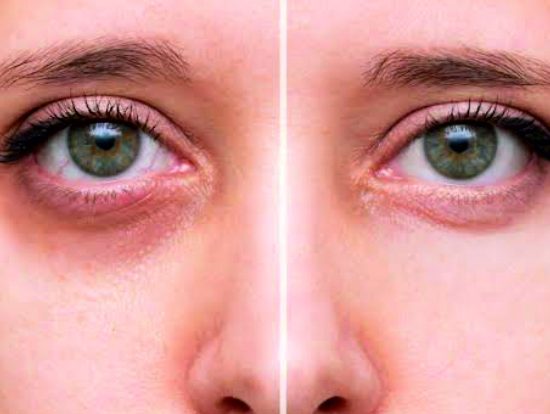 16-Under Eye Dark Circles Treatment 16-Under Eye Dark Circles Treatment