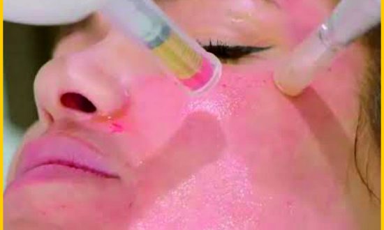 17-Vampire Facial (Red Plasma Facial) Treatment