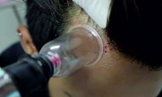 20-Cupping Therapy