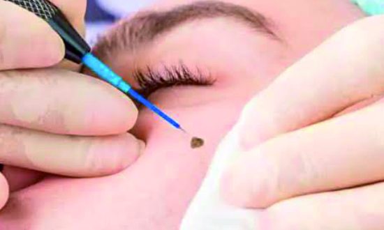 22-Mole, Wart Removal