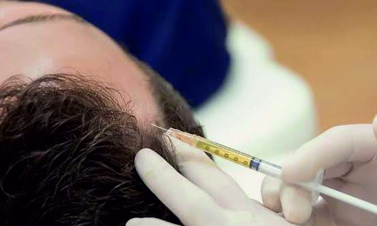 29-I-PRF Hair Regrowth Treatment