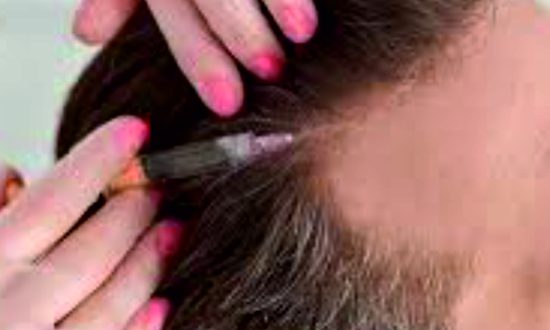 31-Exosome Hair Regrowth Treatment