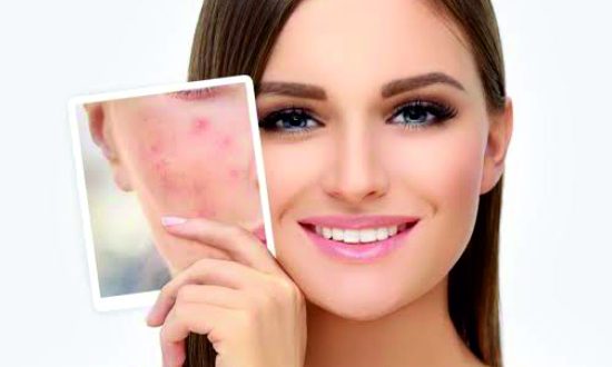 1-Acne, Pimple, Zap, Acne Scars Treatment